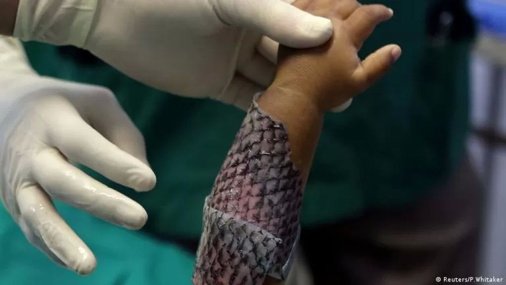 العلاج بقشور سمك البلطي