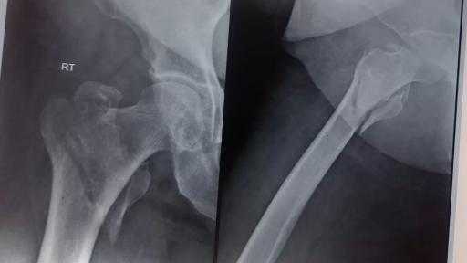 تدخل جراحي دقيق بمستشفى صدر المنيا… ينجح في علاج كسر معقد بمفصل الفخذ لسيدة مسنة